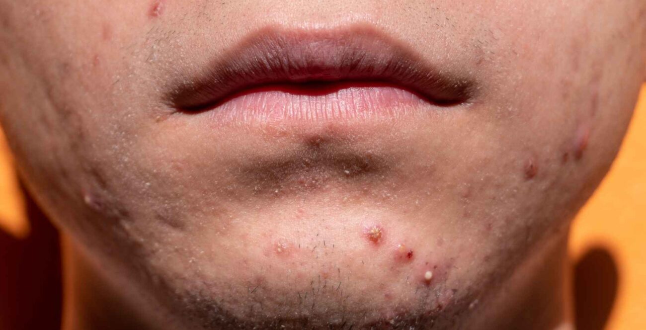 por que quedan cicatrices de acne y como tratarlas