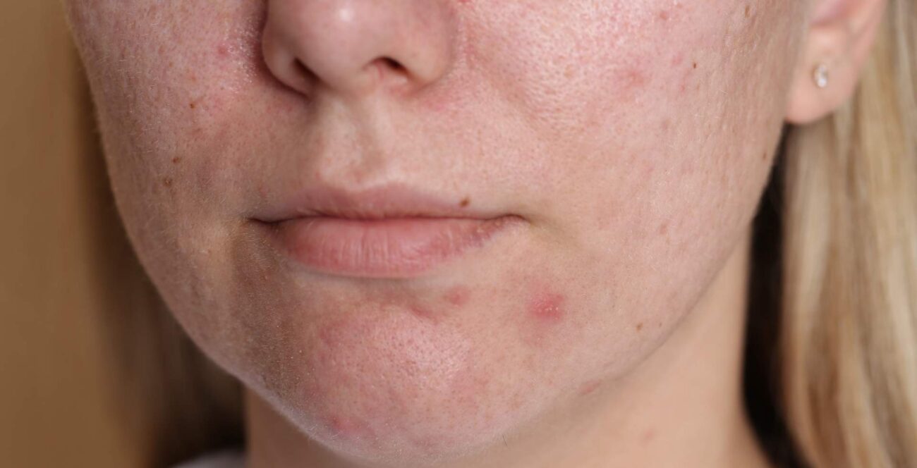 como eliminar cicatrices de acne en la cara tratamientos efectivos