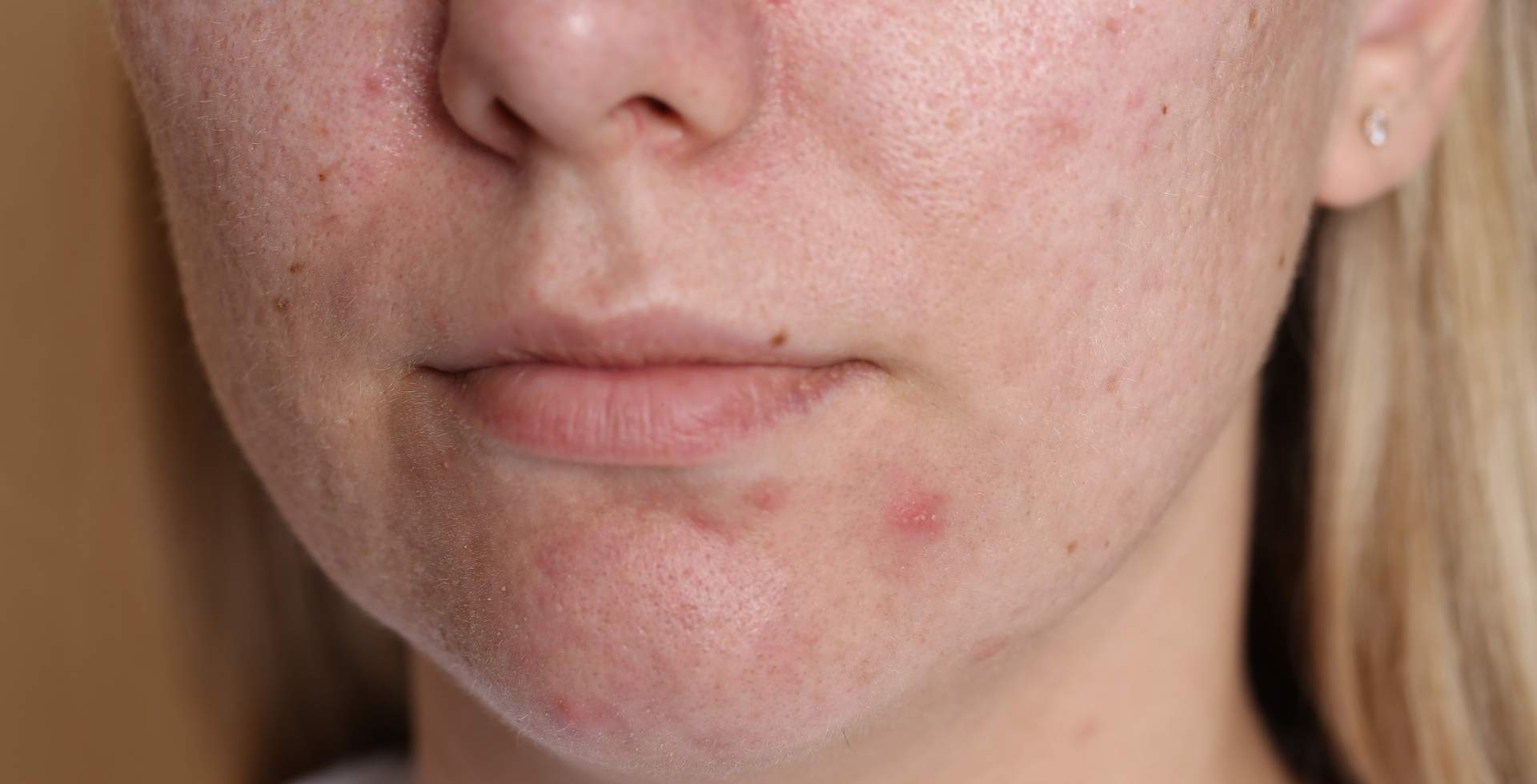 como eliminar cicatrices de acne en la cara tratamientos efectivos