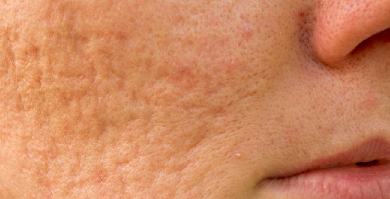 que tipo de cicatriz de acne tienes y como identificarla