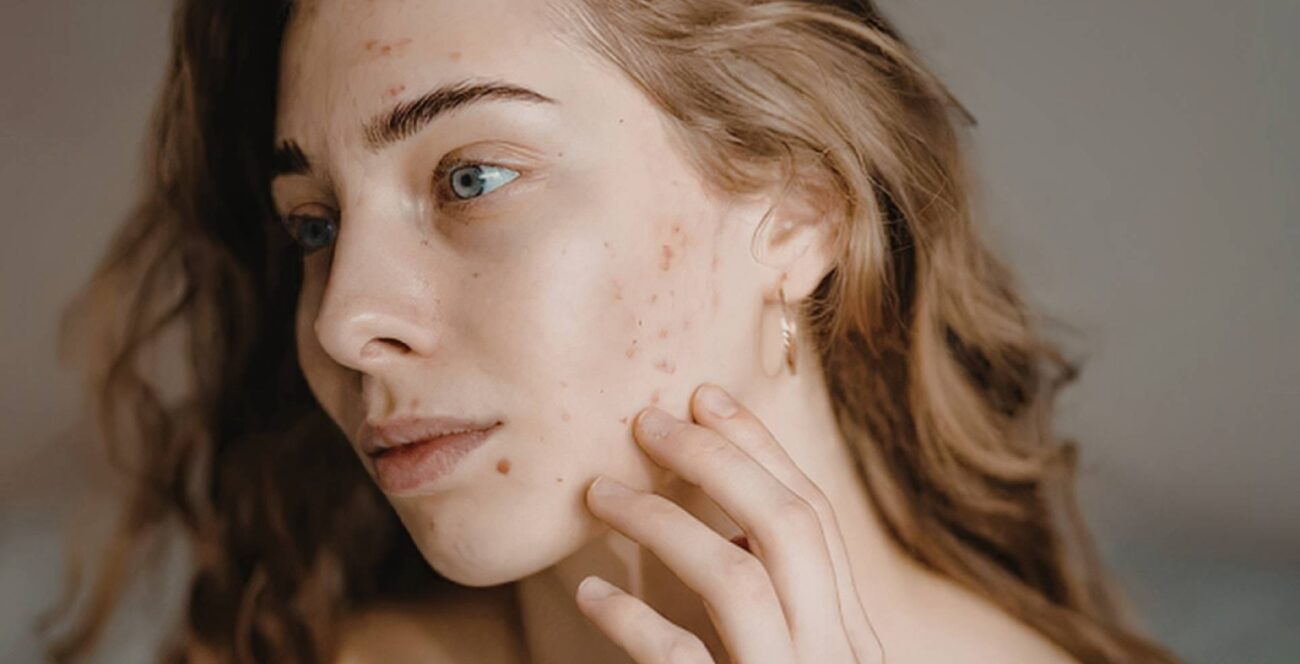 diferencia entre manchas y cicatrices de acne como identificarlas