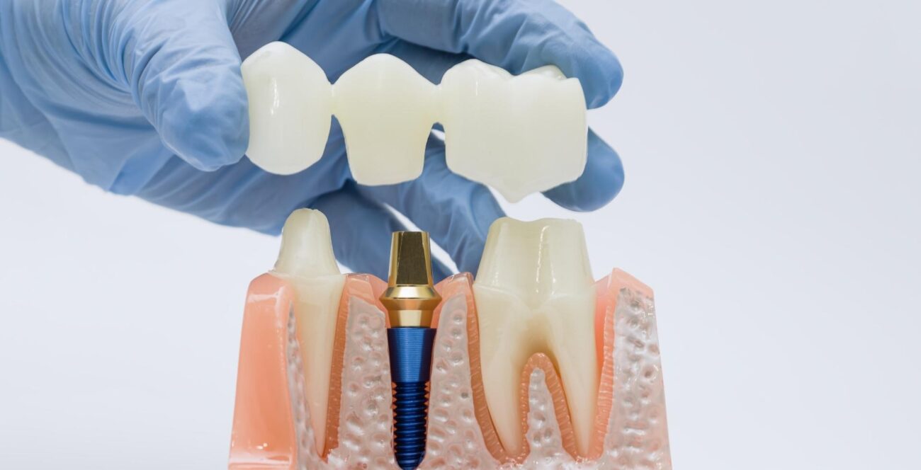 implantes coronas y carillas diferencias cual elegir tratamiento dental