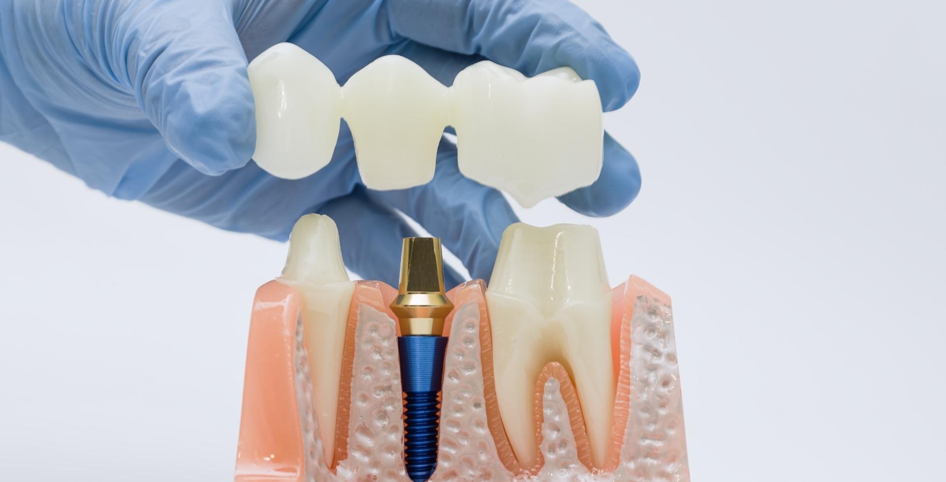 implantes coronas y carillas diferencias cual elegir tratamiento dental