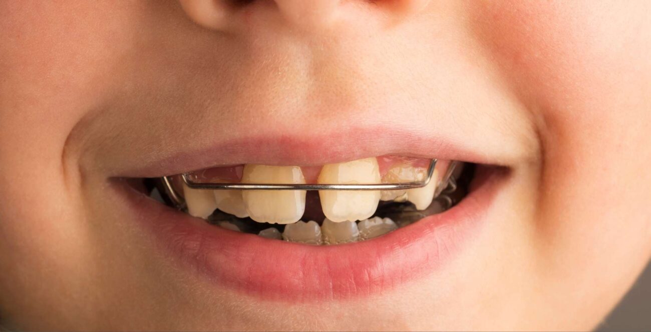Ortopedia maxilar infantil aplicada a un niño en consulta dental