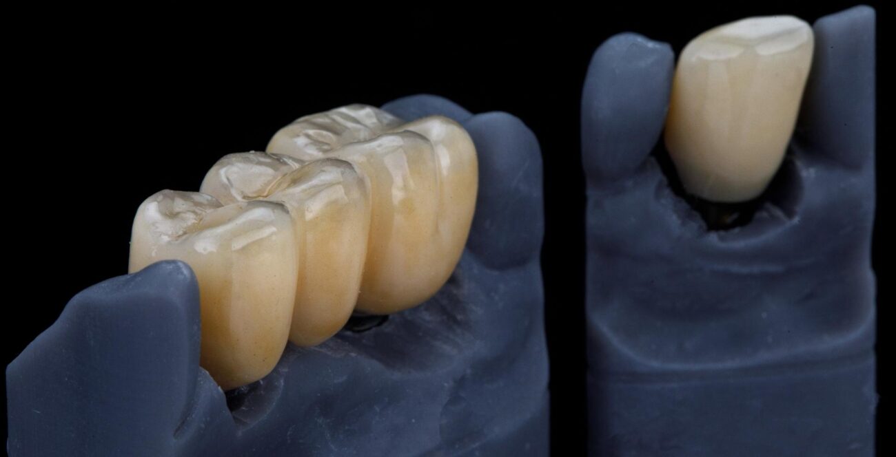 Corona dental de porcelana sobre un diente preparado