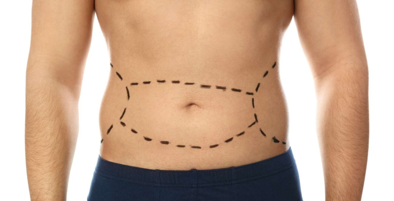Resultado de lipoescultura masculina en abdomen