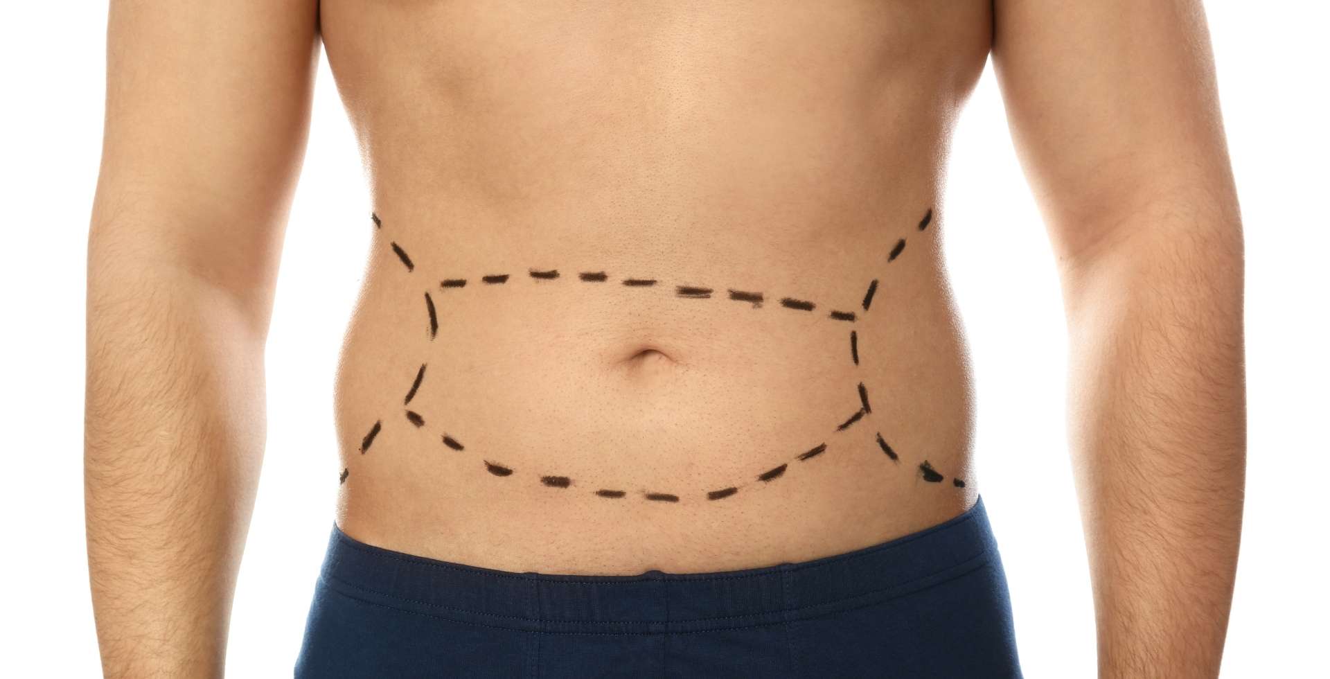 Resultado de lipoescultura masculina en abdomen