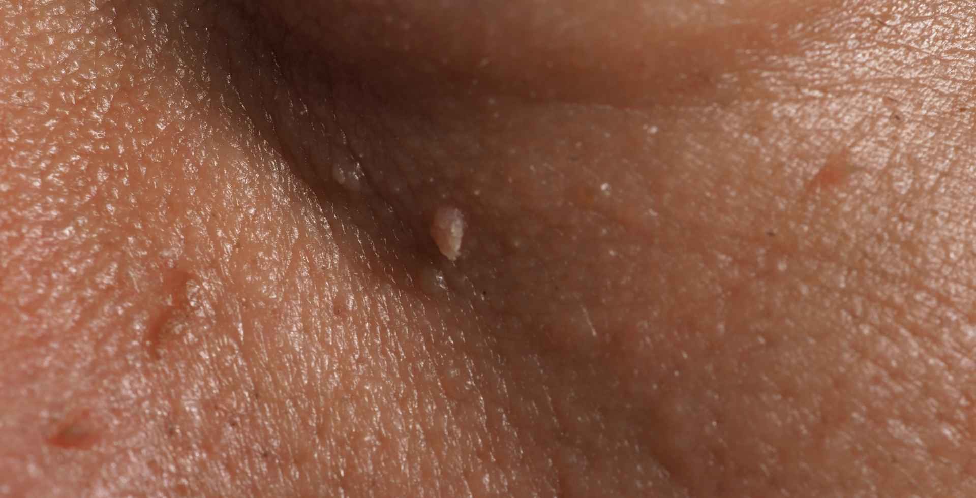 Dermatóloga realizando cirugía de verrugas en consulta en Guayaquil
